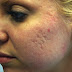 Acne Medications For Mild To Moderate Acne Breakout