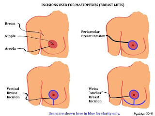 Surgical Procedures of Mastopexy