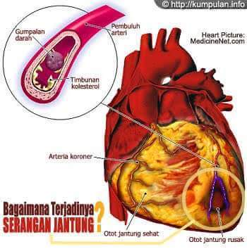 INFORMASI PENTING JANTUNG KORONER YANG WAJIB DIKETAHUI