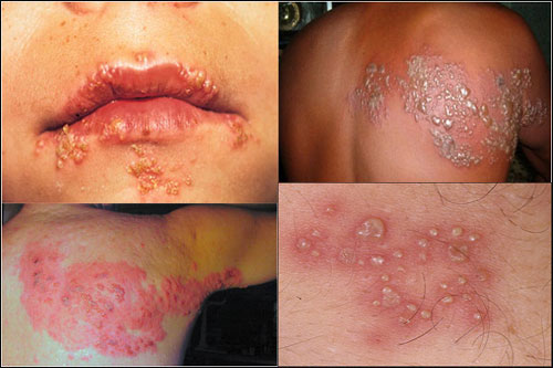 penyakit herpes bisa disembuhkan