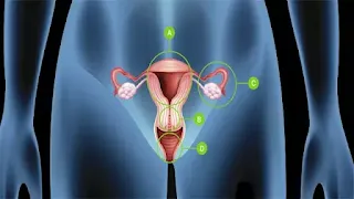 Hystérectomie vaginale