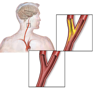 What is Carotid Artery Disease