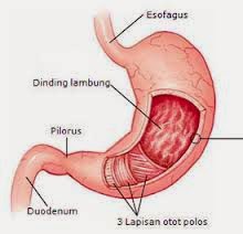 Pengobatan Tukak Lambung Secara Alami