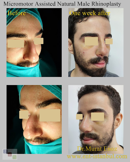 Micro-motor assisted male rhinoplasty - Nose job for men - Crooked nose aesthetic in Istanbul