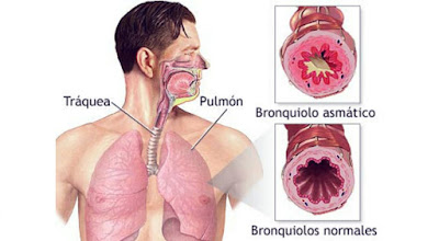 tips mengatasi asma