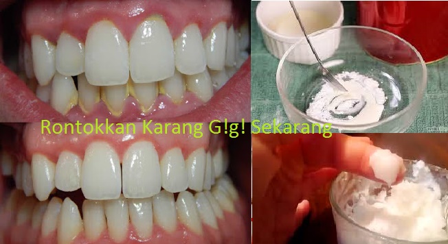 SUDAH TERUJI KHASIATNYA SUNGGUH LUAR BIASA...!!! TERNYATA MERONTOKKAN KARANG GIGI SANGATLAH MUDAH" KALAU TAU CARANYA...(MARI GUYS LANGSUNG PRAKTEKAN)