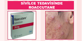 sivilce tedavisi Roaccutane ilacı