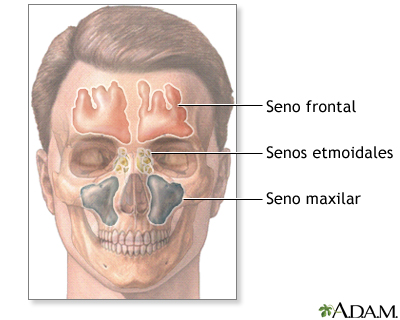 Sinusitis Crnica Sntomas Y Causas Mayo Clinic Sinusitis Crnica Sntomas Y Causas Mayo Clinic