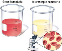 Cara cepat mengobati penyakit hematuria secara alami