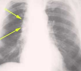 What is pneumatic dilatation? - Procedure, Complications, CPT code