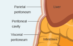 Peritoneal Mesothelioma — The Cancer Of Abdominal Lining