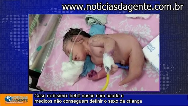 Caso raríssimo: bebê nasce com cauda e médicos não conseguem definir o sᕮxo da criança