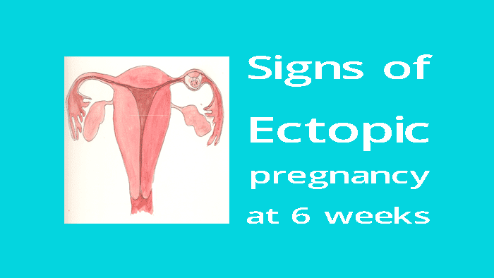 signs of ectopic pregnancy at 6 to 12 weeks