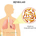  Lao phổi là gì? Nguyên nhân và dấu hiệu nhận biết