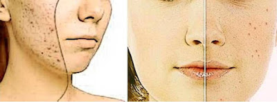 Decide Effective Treatment of Acne Scars to Get Best Results