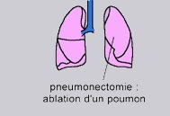 effets secondaires radiothérapie lymphome