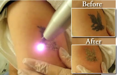 Tattoo Removal