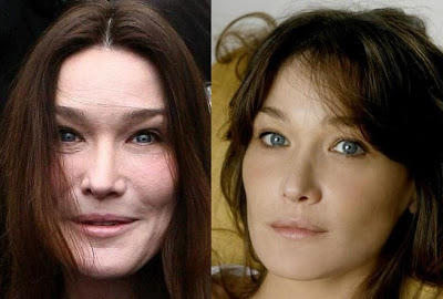 Carla Bruni plastic surgery before and after? (image hosted by plasticsurgerycelebrity.com)