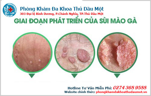 Chứng bệnh sùi tăng trưởng có nhanh lắm không - Các giai đoạn phát triển bệnh