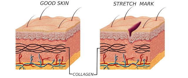 Beda Stretch Mark dan Selulit