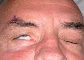 Lagopthalmos affected to obicularis muscle, that cause inability of closing eyelids fully disease pictures