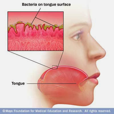 Bad Breath due to poor oral hygiene. 