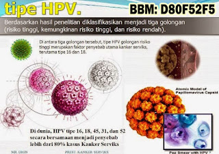 Obat Kutil Kelamin, Cara Mengobati Kutil Dikemaluan Kelamin Dari Rumah Sendiri, Dokter Obat Kutil Kelamin Terbukti Terbaik Dan Terpercaya