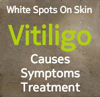 White Spots On Skin (Vitiligo) : Causes, Symptoms And Treatment !