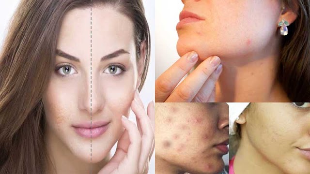 How to Get Rid of Acne Overnight Guaranteed