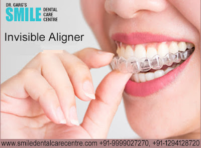 Best Invisible Aligner Treatment in Faridabad