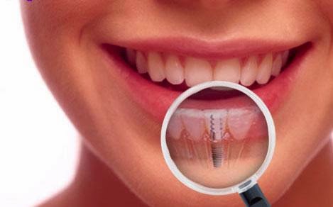 Dental Implants Cost