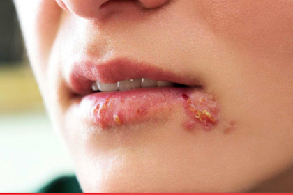 Get Rid Of Herpes Using A Simple Trick