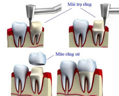 Mài răng nanh nhọn có hại không?