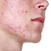 Acne: Five Most Popular Causes