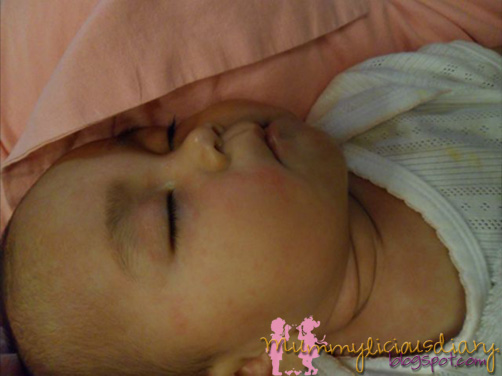 pictures of heat rash on babies. heat rash baby face. aby heat