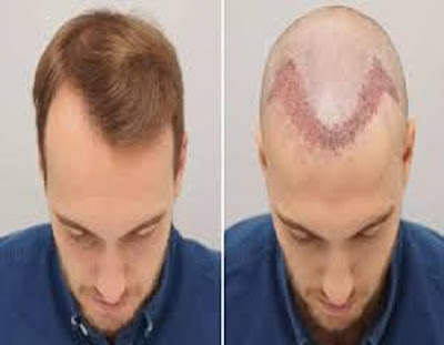  Hair Transplant Clinic In Mumbai   