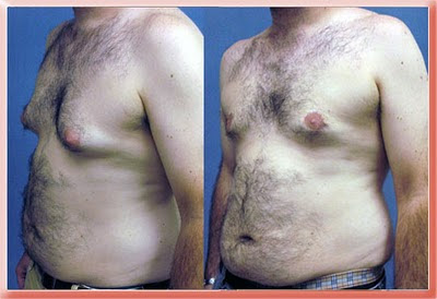 gynecomastia