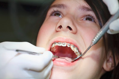 Nắm rõ nguyên nhân gây ê răng khi niềng răng-2