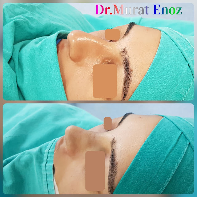 femal nose job,rhinoplasty operation in istanbul,nose job for women,thick skinned nose aesthetic,Ethnic rhinoplasty,nose job for thick skinned nose,