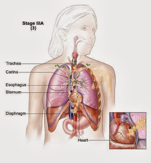 Types Of Most Common Cancer,Early Skin Cancer,Primary Liver Cancer,Most Common Cancer Types