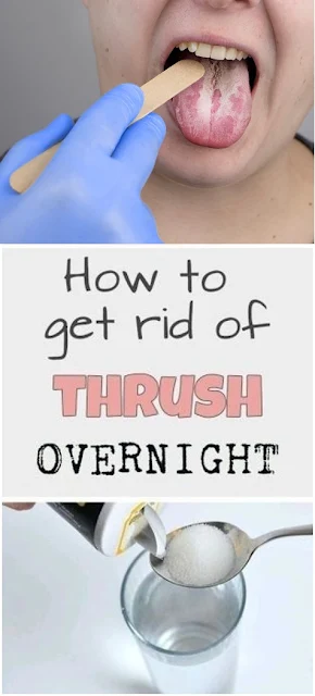 9 Methods for How to Battle Oral Thrush