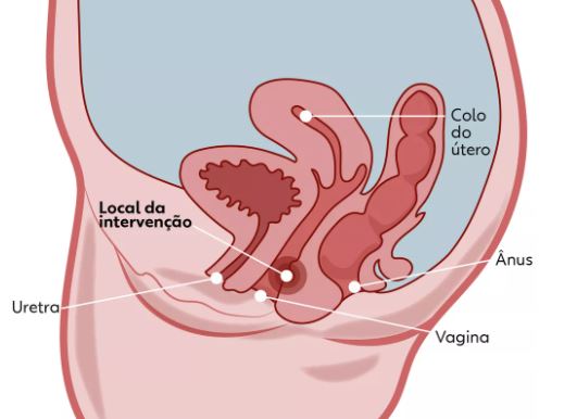 PONTO H: Preenchimento da vagina para dar mais prazer ao homem ganha adeptas; entidade diz que técnica é enganosa