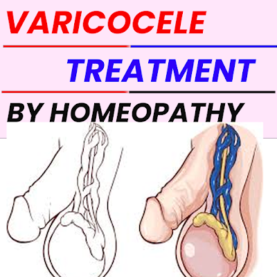 Varicocele treatment by homeopathy