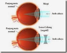 Kelainan-kelainan pada Mata (6)