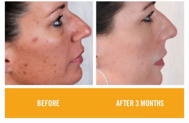 rodan and fields before and after results 15 638