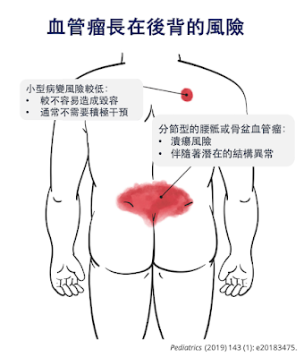 嬰兒血管瘤在後背上的風險，下背骨盆上得注意