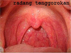 Radang Tenggorokan