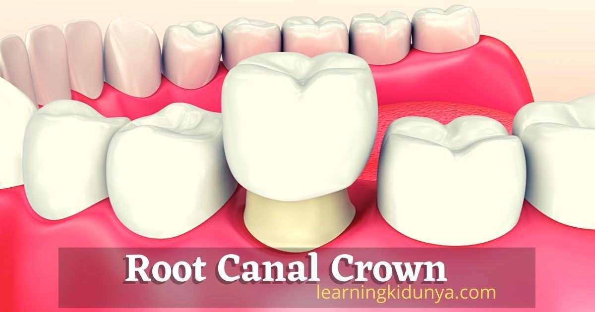 Myths!! People Don't Know About Root Canal Crown.