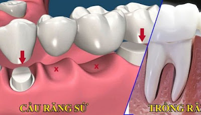 Chi phí cấy ghép răng Implant nha khoa