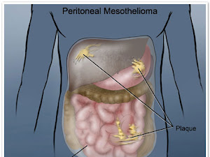 Mesothelioma Adalah Kanker Saluran Paru